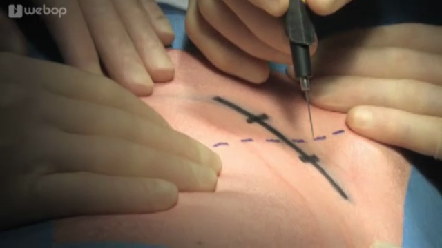33 - Anal fistula, closure with Anal Fistula Plug® (AFP®)