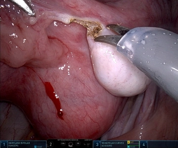 Salpingectomía derecha