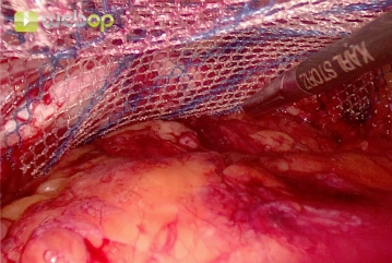 Placement of the meshes