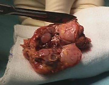 Extracción del preparado, drenaje