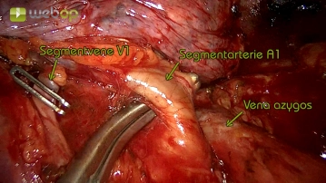 Preparation and transection of the segment artery A1
