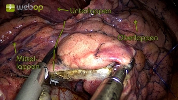 Dissection of the minor fissure