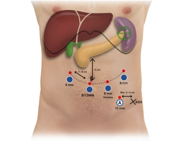 504-Trokare-2 beide  Systeme.jpg