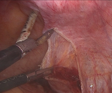 Apertura del retroperitoneo