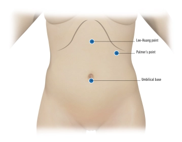 Posicionamiento del trócar en el punto de Palmer