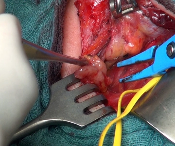 Partial Resection of the Ipsilateral Central Lymph Node Compartment
