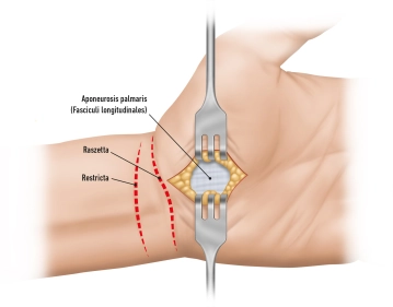 Planning/Skin Incision 1