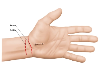 Irrigation and skin suture 1