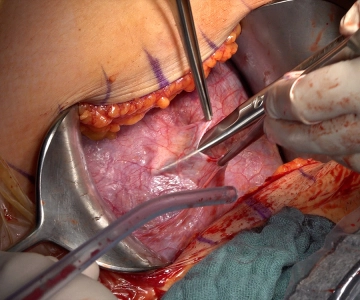 Preparation of the urinary bladder 1