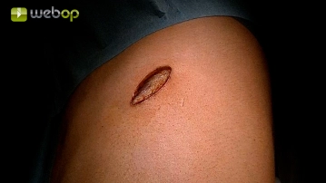 Access uniportal VATS and extrapleural preparation