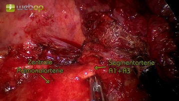 Preparation of the pulmonary artery