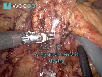 Dissection of the Right Gastroepiploic Artery and Vein