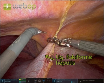 Division of the Ligamentum teres and Ligamentum falciforme hepatis