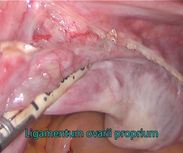 Vascular mesometrium and broad ligament on the right 1