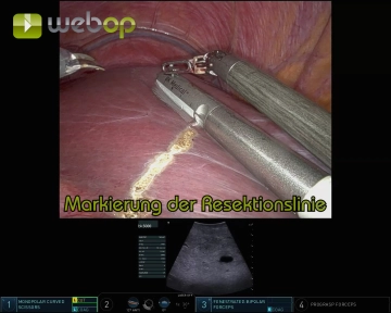 Intraoperative Sonography and Marking the Resection Line