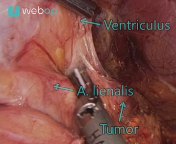 Entrada a la glándula suprarrenal