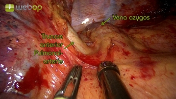 Preparation of the lung hilum with visualization of the anterior trunk