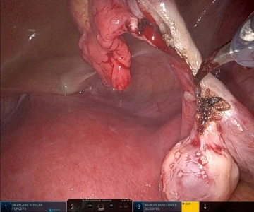 Right salpingectomy