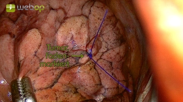 Exploration and tumor marking
