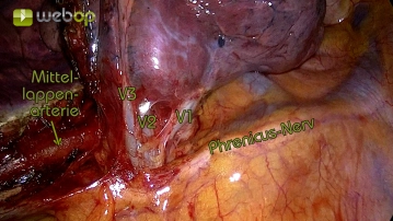 Preparation of the Segment-3 vein