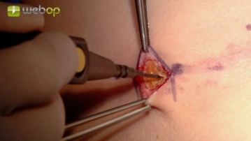 Preparation of the entry points