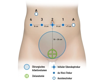 Trocar positioning and docking