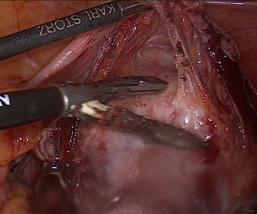 Preparación de la vejiga urinaria