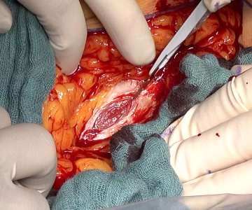 Opening of the abdominal wall 1