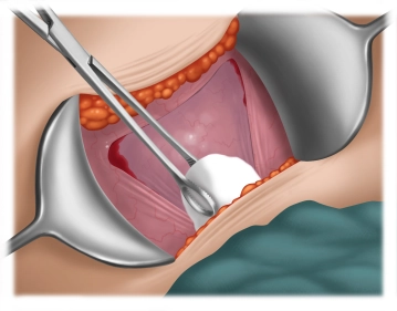Preparation of the urinary bladder 3