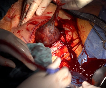 Retrieval of the placenta and fetal membranes