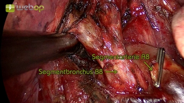 Resection of the segmental bronchus B8