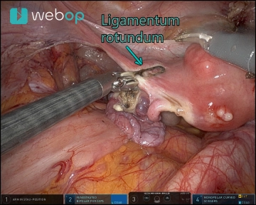 Adnexectomía, mesometrio vascular y ligamento ancho izquierdo