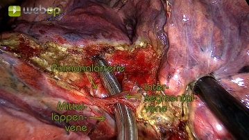 Dissection of the intersegmental vein