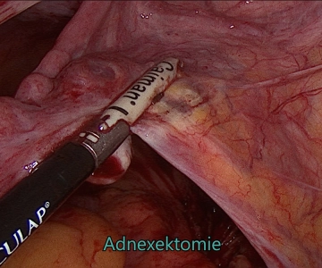 Adnexectomía y aparato de sujeción parametral derecho 1
