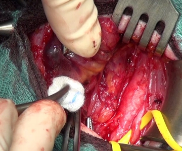 Visualization of the Recurrent Laryngeal Nerve to the Larynx