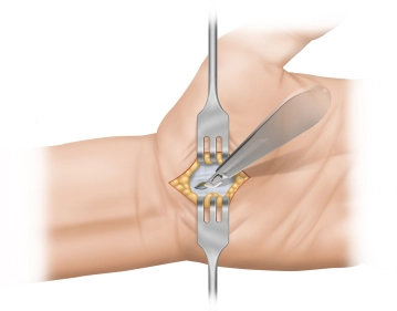 Transection of Palmar Aponeurosis 1
