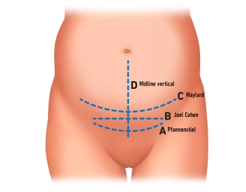 Marking incision line