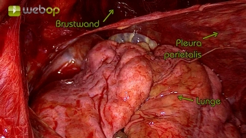 Resection of the apical parietal pleura