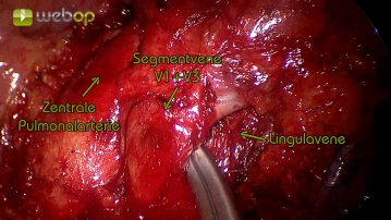 Dissection of the segmental veins V1 to V3