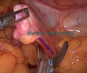 Right infundibulopelvic ligament