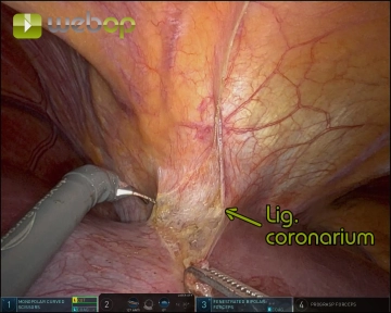Exposure of the suprahepatic inferior vena cava