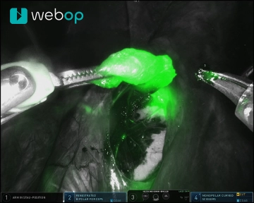 Biopsia de ganglio centinela pélvico 2