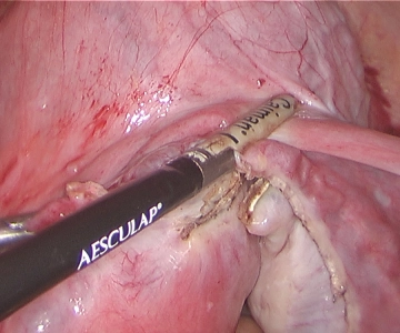 Vascular mesometrium and broad ligament on the right 2