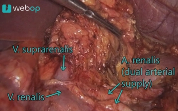 Movilización del tumor suprarrenal