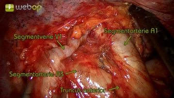 Visualization and dissection of the segmental vein V1