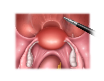 Adnexectomía y aparato de sujeción parametral derecho 3