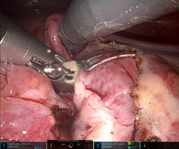 Right ovarian ligament