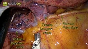 Preparation of the upper lobe vein