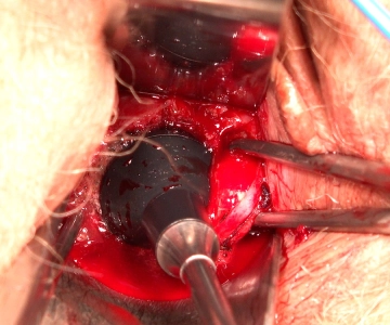 Termocoagulación del cráter de conización