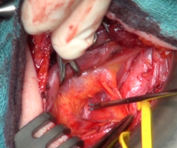 Identification of the Recurrent Laryngeal Nerve